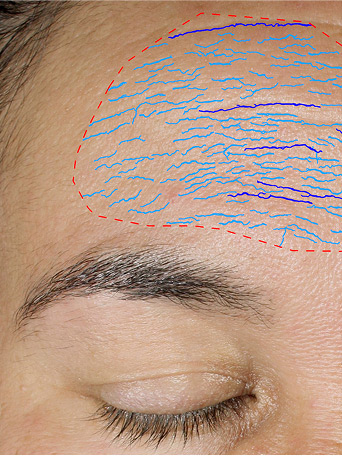 Before using Mary Kay TimeWise Repair VoluFirm Set on the forehead area