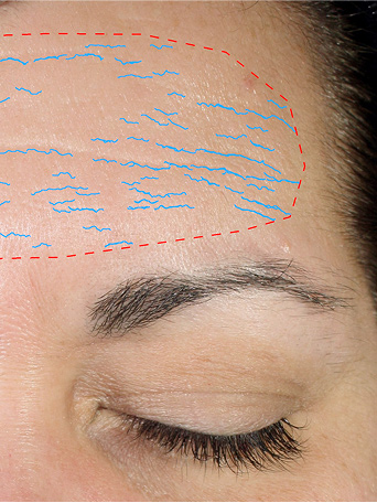 After using Mary Kay TimeWise Repair VoluFirm Set on the forehead area