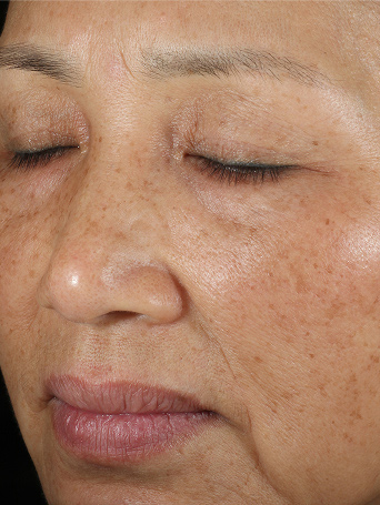 Before using Mary Kay TimeWise Repair VoluFirm Set on the cheek area