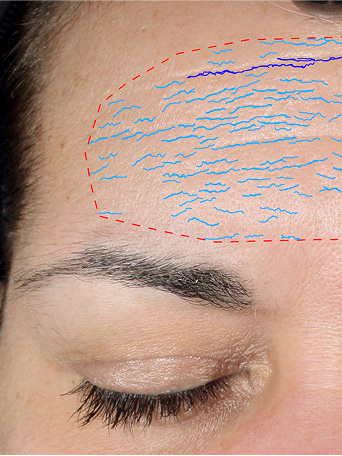 Before using Mary Kay TimeWise Repair VoluFirm Set on the forehead area