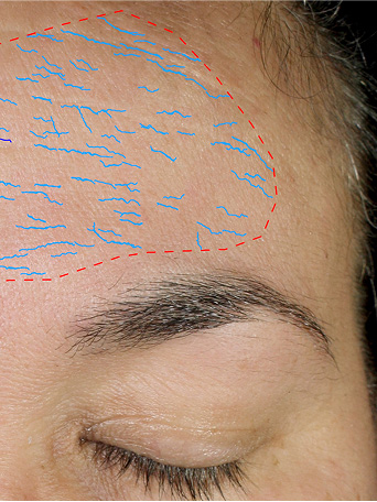 After using Mary Kay TimeWise Repair VoluFirm Set on the forehead area