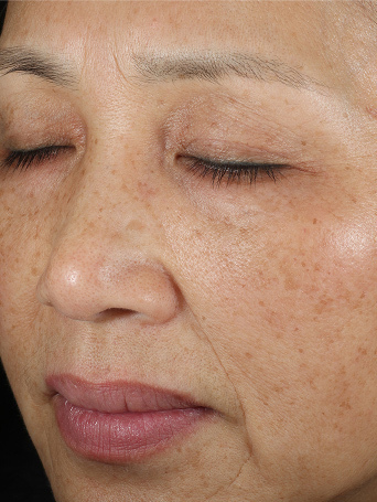 After using Mary Kay TimeWise Repair VoluFirm Set on the cheek area